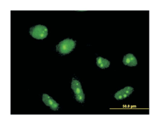 Caracteristicile genetice ale cilindromatozei familiale, identificate de cercetătorii britanici