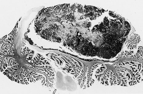 O nouă metodă pentru a bloca evoluţia meduloblastomului, identificată de cercetători din SUA