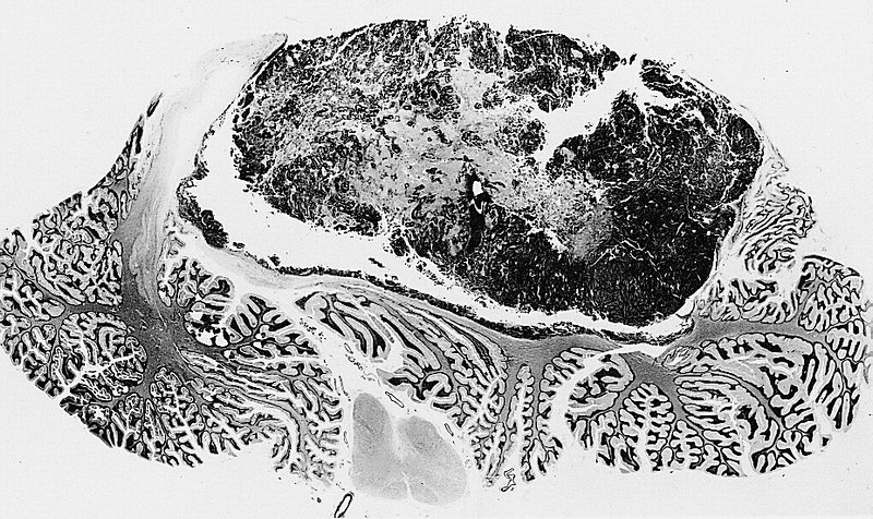 O nouă metodă pentru a bloca evoluţia meduloblastomului, identificată de cercetători din SUA