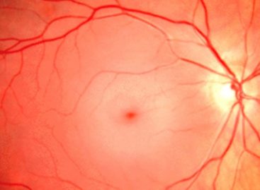 OACR, o urgenţă oftalmologică. Consultul medical îţi poate salva vederea!