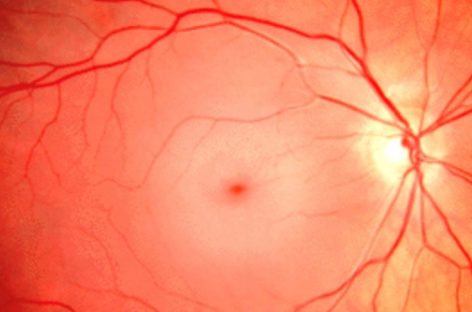 OACR, o urgenţă oftalmologică. Consultul medical îţi poate salva vederea!