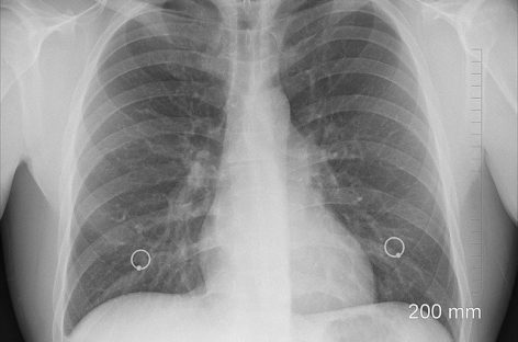 Covid-19: Tomografia toracică are o sensibilitate mai mare decât testarea coronavirusului în laborator