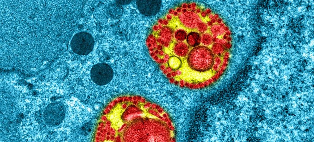 Coronavirus in celulă Primele dovezi despre o persoană reinfectată cu noul coronavirus