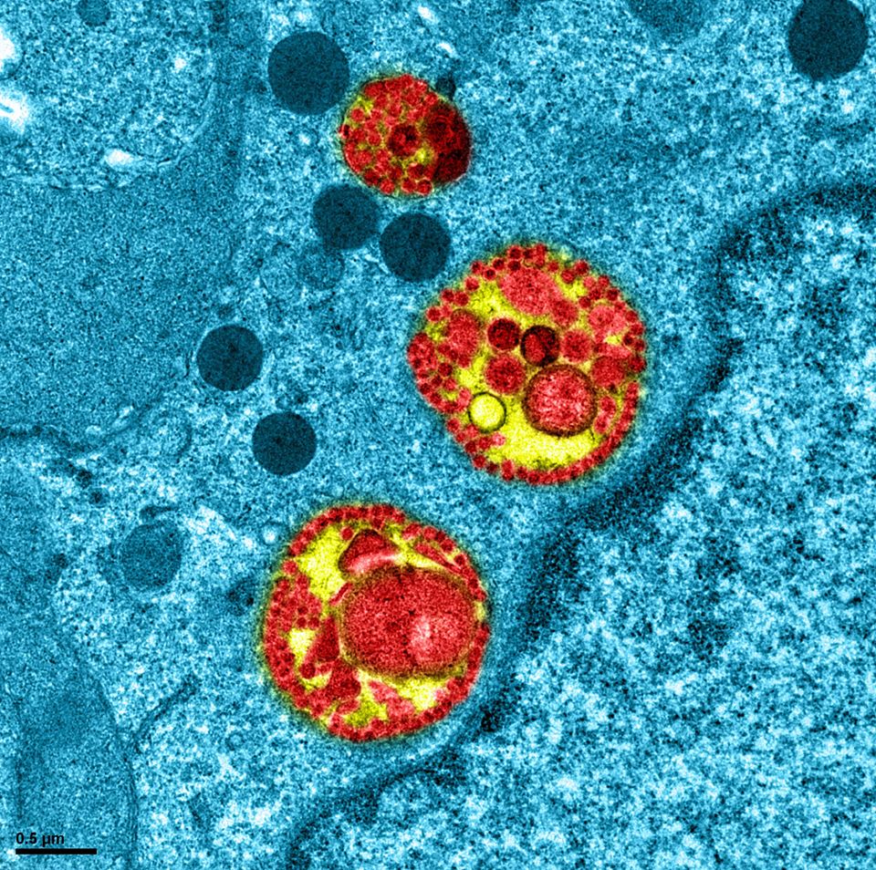 Primele dovezi despre o persoană reinfectată cu noul coronavirus