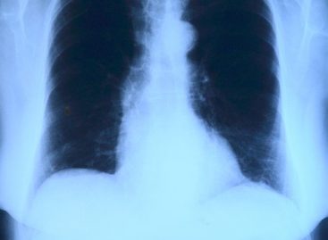 Inteligența artificială în screeningul cancerului pulmonar ar putea reduce substanțial volumul de muncă al radiologilor