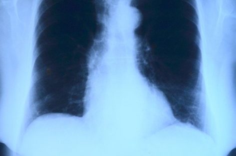 Inteligenţa artificială în screeningul cancerului pulmonar ar putea reduce substanţial volumul de muncă al radiologilor