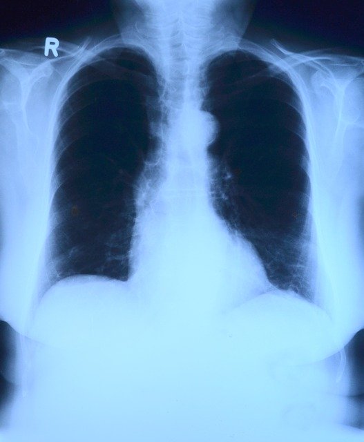 Inteligenţa artificială în screeningul cancerului pulmonar ar putea reduce substanţial volumul de muncă al radiologilor