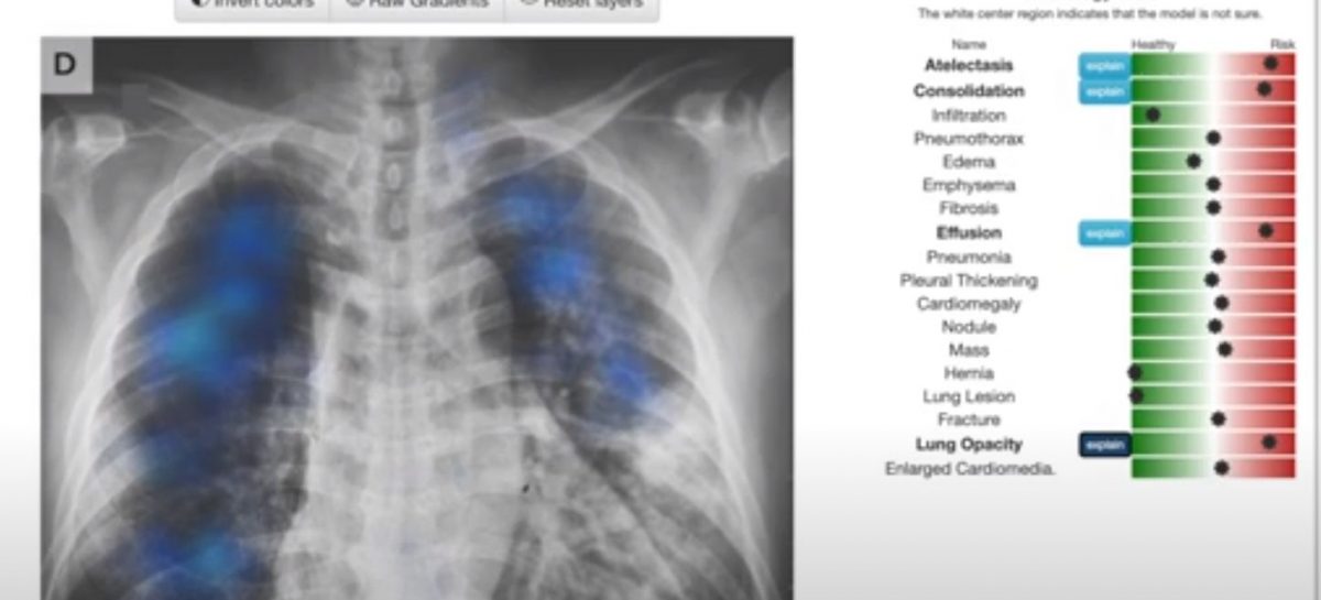 Instrument gratuit de citire a radiografiilor toracice, disponibil online