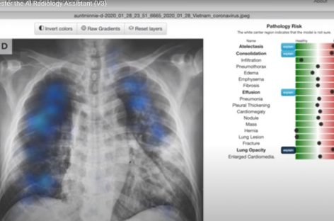 Instrument gratuit de citire a radiografiilor toracice, disponibil online