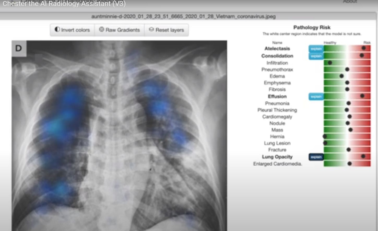 Instrument gratuit de citire a radiografiilor toracice, disponibil online