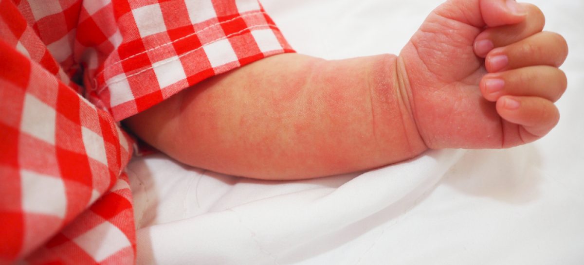 Dermatită atopică Diagnosticarea unor pacienți cu dermatită atopică în România, între o lună și 2 ani