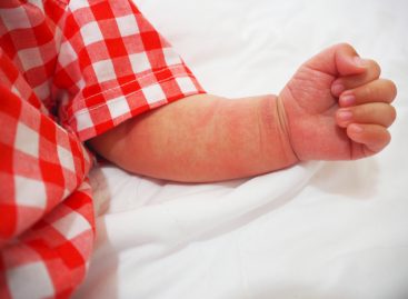 Gena pentru sinteza hormonilor sexuali ar putea juca un rol cheie în tratarea dermatitei atopice