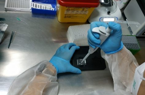 Primul test PCR din lume pentru cancerul oral ar putea revoluţiona diagnosticul şi tratamentul afecţiunii