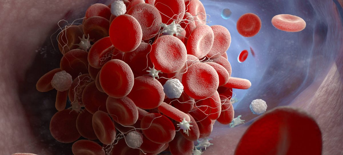 Cheag de sânge 3 semne care te ajută să recunoști un accident vascular cerebral. 29 octombrie – Ziua Mondială de Luptă Împotriva Accidentului Vascular Cerebral