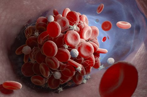 Un nou mecanism de formare a cheagurilor periculoase de sânge, descoperit de cercetători