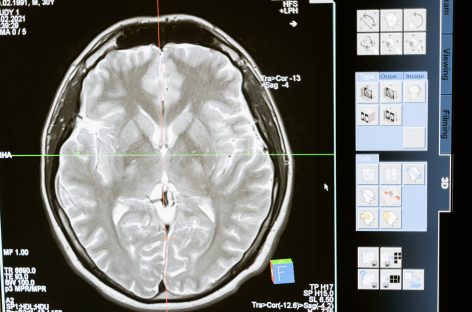 Anevrismele cerebrale pot fi detectate mai uşor cu ajutorul inteligenţei artificiale