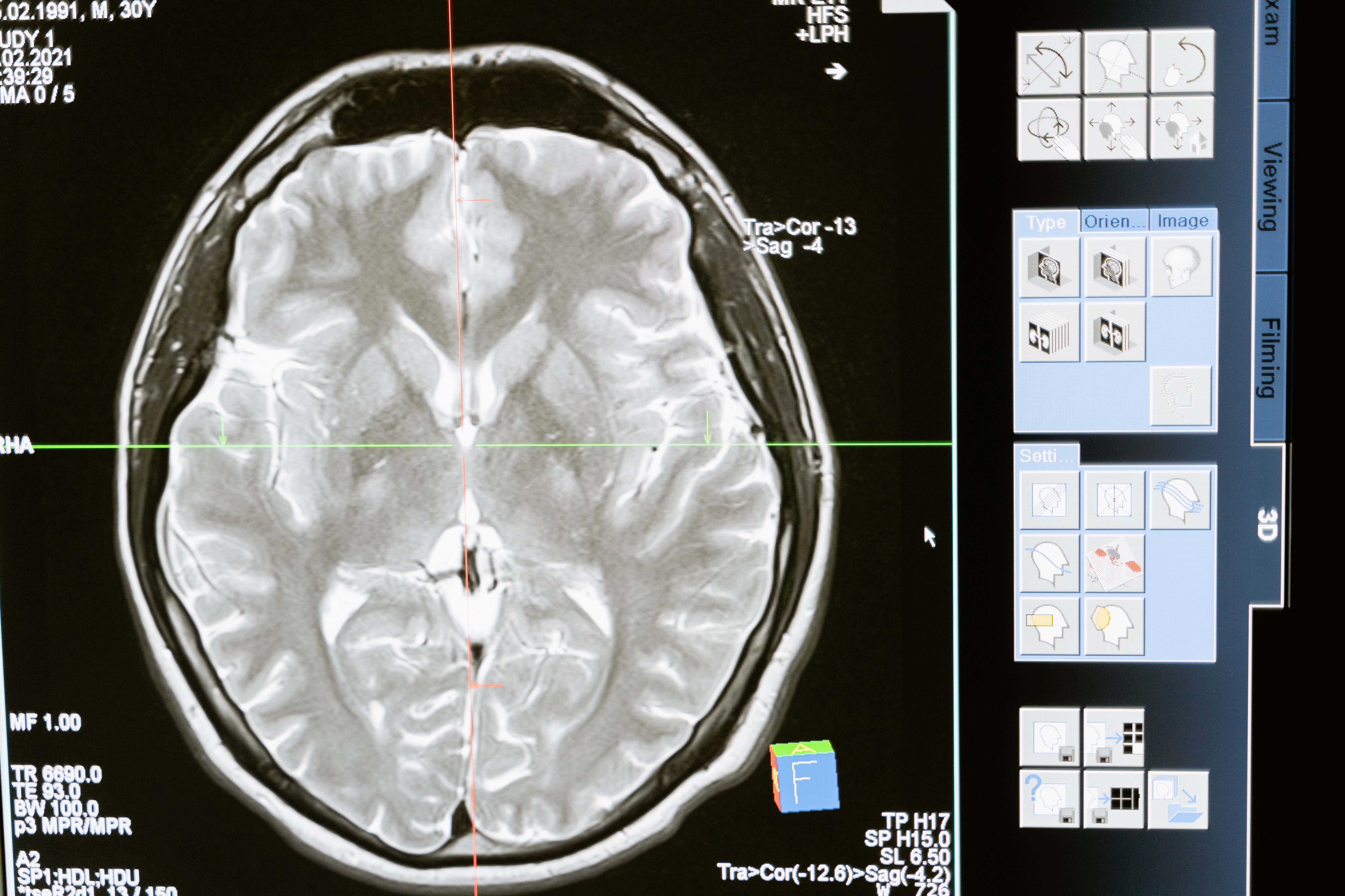 Anevrismele cerebrale pot fi detectate mai uşor cu ajutorul inteligenţei artificiale