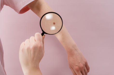 Tratamente de piele identificate recent ar putea elimina nevii congenitali și preveni melanomul