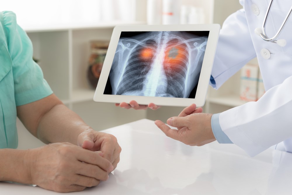 Investigaţii imagistice pentru diagnosticul cancerului pulmonar