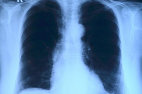 O combinaţie de tratament, promisiune împotriva anumitor cancere pulmonare