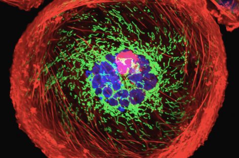 Cancerul de sân: caracteristici distincte descoperite la nivel de genom