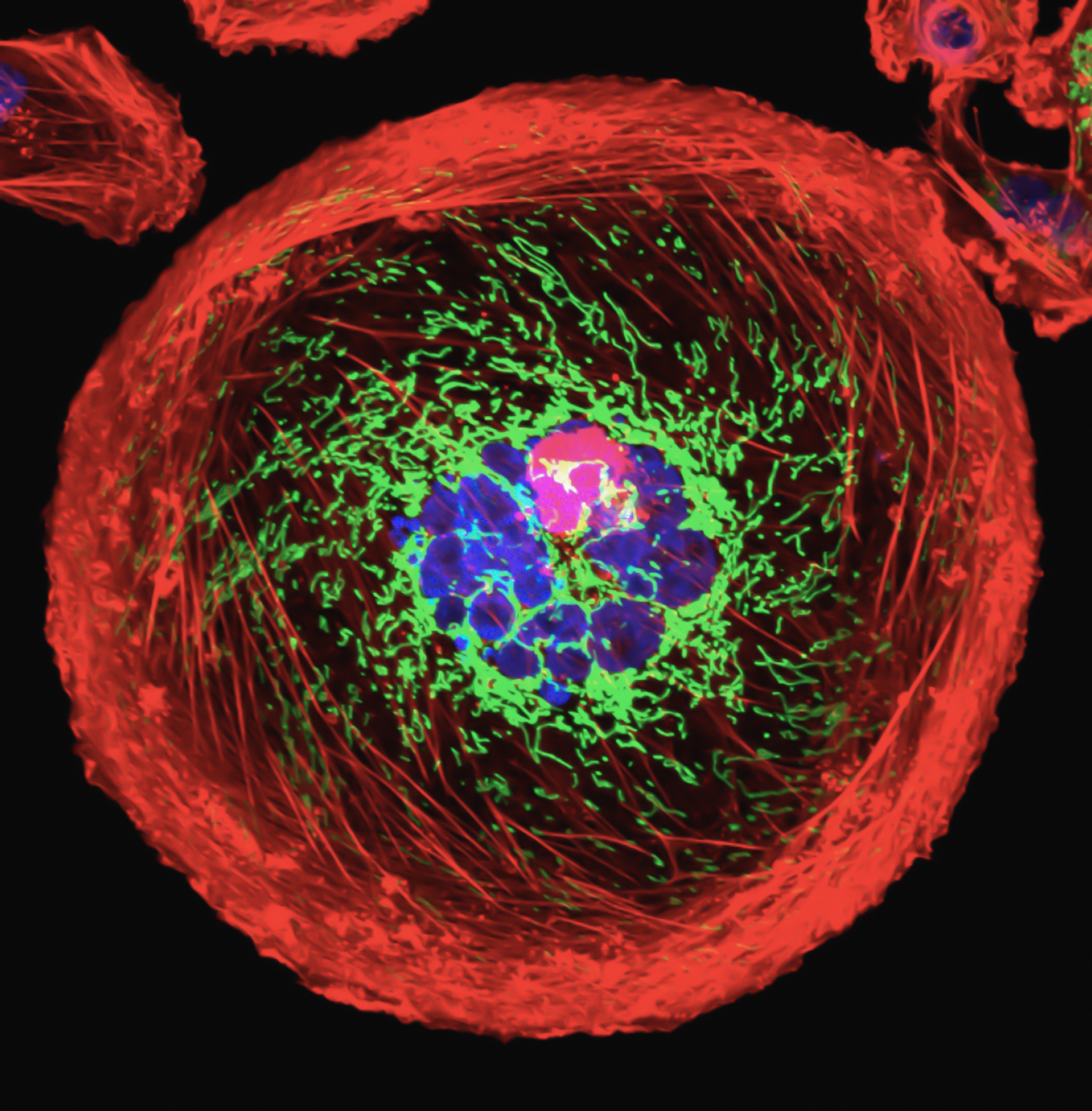 Cancerul de sân: caracteristici distincte descoperite la nivel de genom