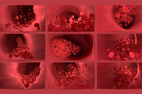 Îndepărtarea unor proteine din pereții vaselor de sânge ar putea reduce incidența de infarct și AVC
