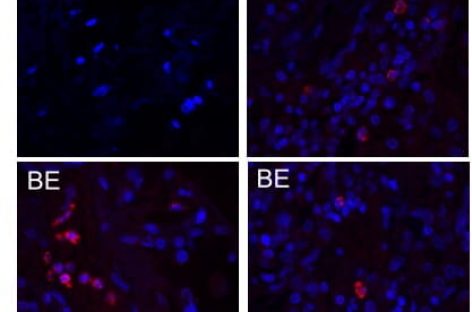 Bacterii considerate inofensive pot agrava bolile pulmonare, indică un studiu internaţional