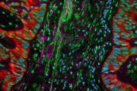 O combinaţie de medicamente a oprit progresia cancerului pulmonar în testele preclinice