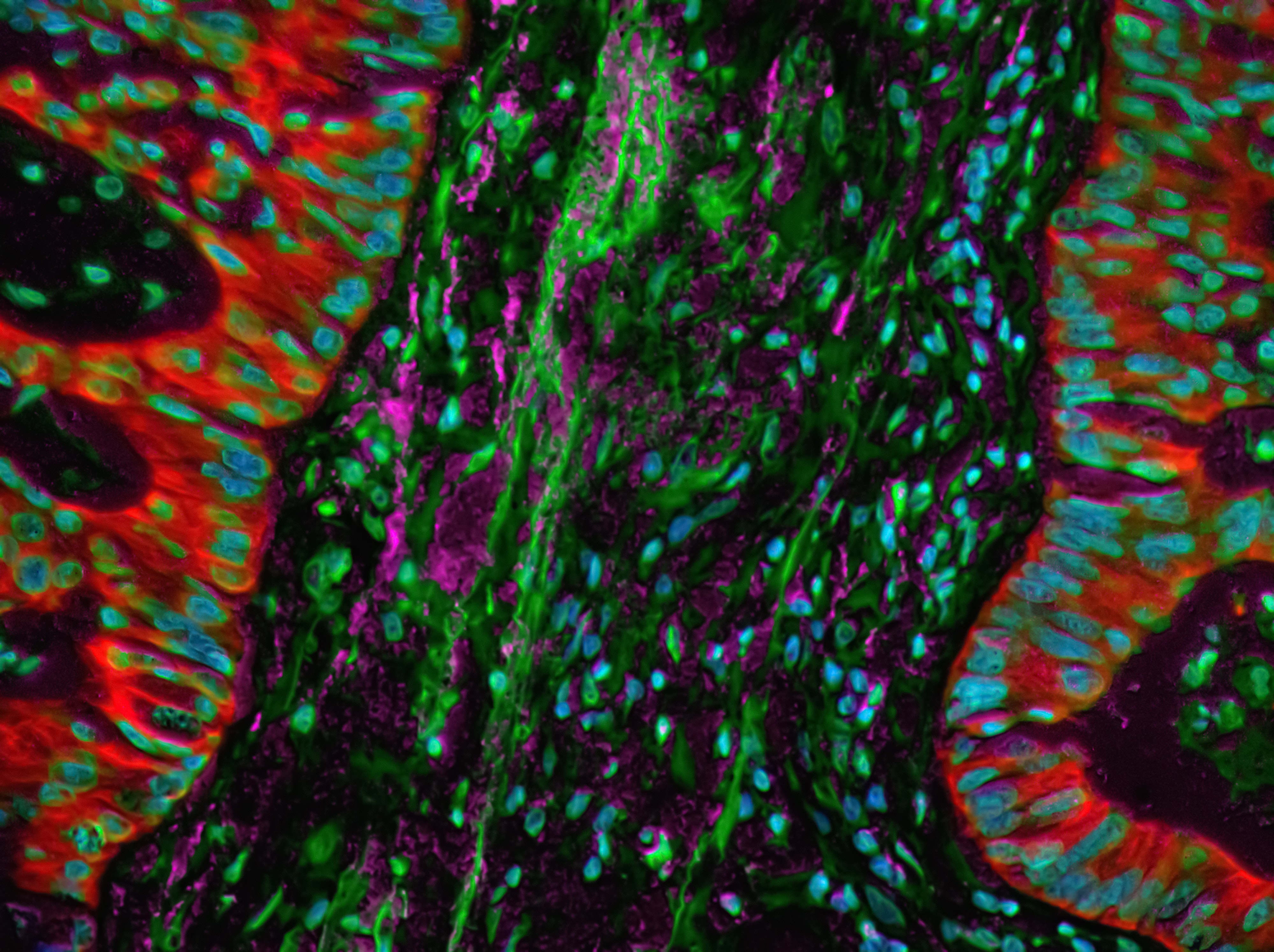 O combinaţie de medicamente a oprit progresia cancerului pulmonar în testele preclinice