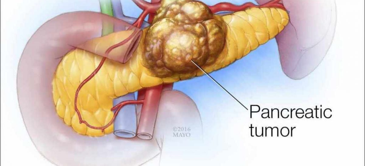 Marker genetic pentru tratarea cancerului pancreatic, identificat