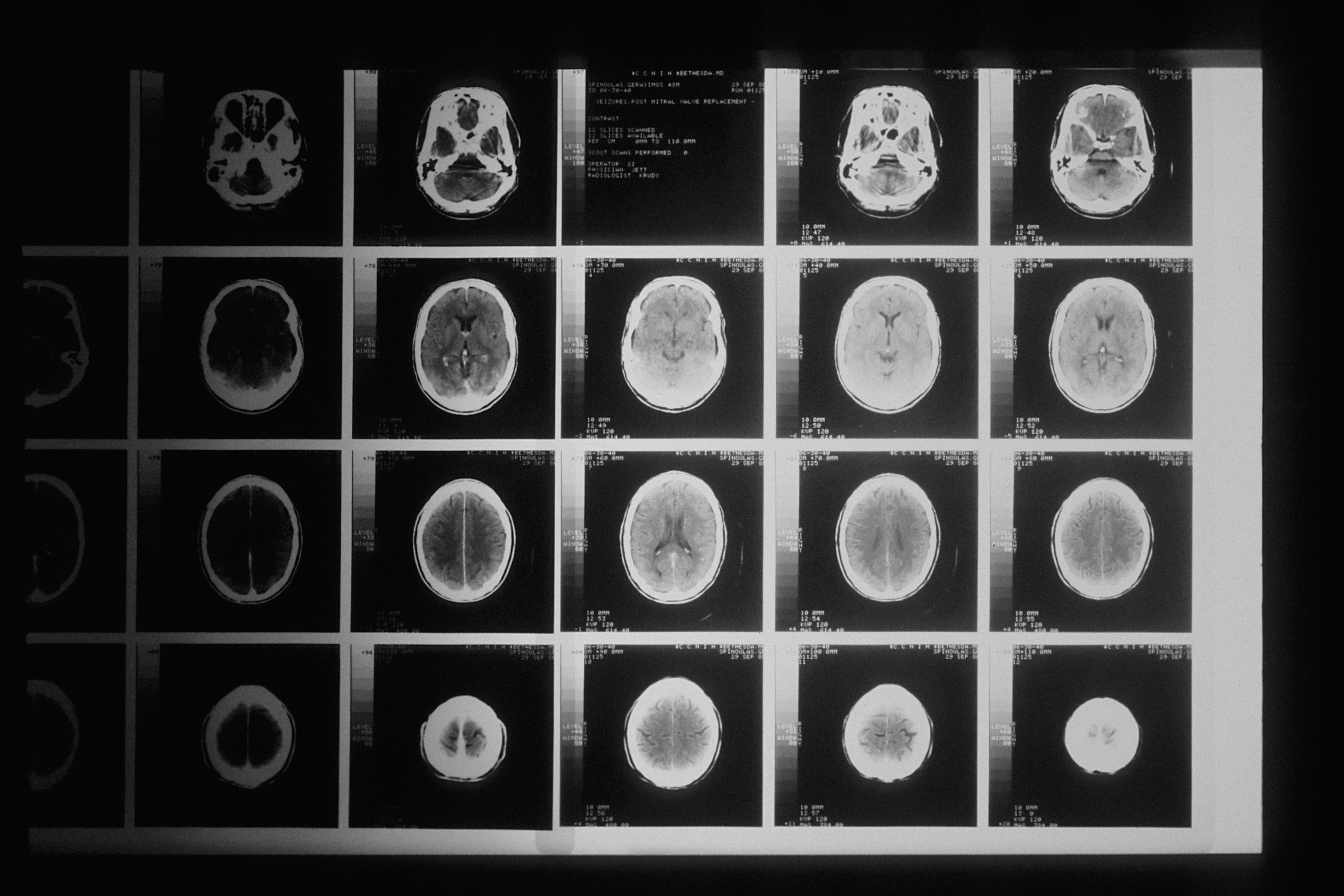 Un tip agresiv de cancer cerebral la copii ar putea fi prevenit