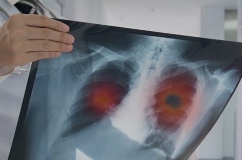 Ascultă-ţi tusea! Îndemnul profesioniştilor din domeniul sănătăţii pentru diagnosticarea precoce a cancerului bronho-pulmonar în România