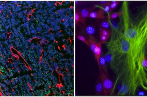 Un tratament care previne răspândirea melanomului la creier, identificat de oamenii de ştiinţă