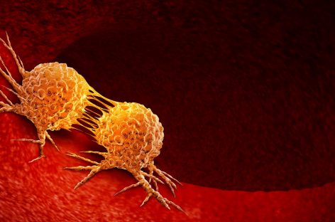 Inhibarea proteinei PAD4 în neutrofile opreşte progresia cancerului şi metastazele