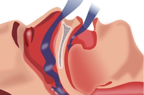 Un medicament promiţător pentru apnee