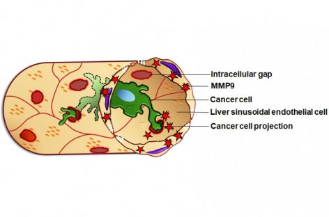 Mecanism folosit de celulele canceroase metastatice pentru a se infiltra în ficat, descoperit de oameni de ştiinţă japonezi