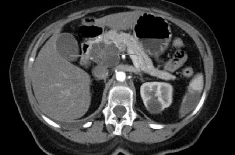 Eşecuri alarmante în depistarea cancerului pancreatic, semnalează specialiştii prezenţi la UEG Week 2022