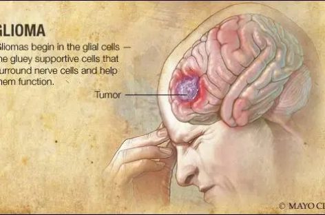 Cercetări recente furnizează informaţii noi despre dezvoltarea glioamelor
