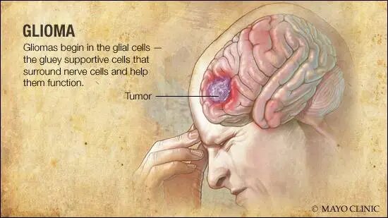 Cercetări recente furnizează informaţii noi despre dezvoltarea glioamelor
