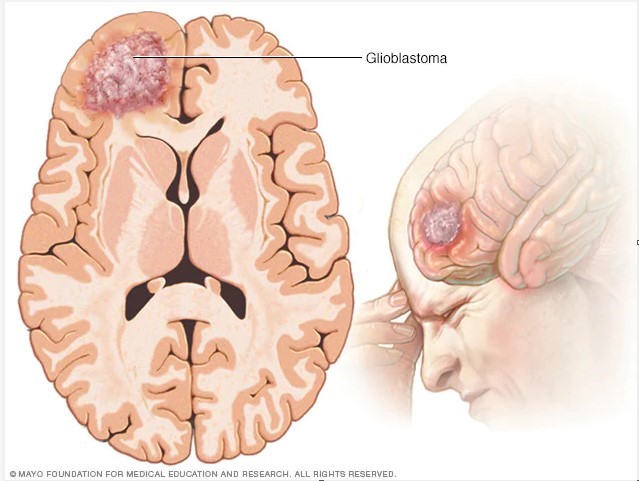 Posibilă ţintă pentru tratarea cancerului cerebral rezistent la tratament