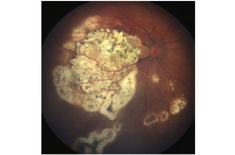 Cercetătorii au descoperit un nou factor molecular pentru retinoblastom, crescând şansele pentru o ţintă specifică de tratament