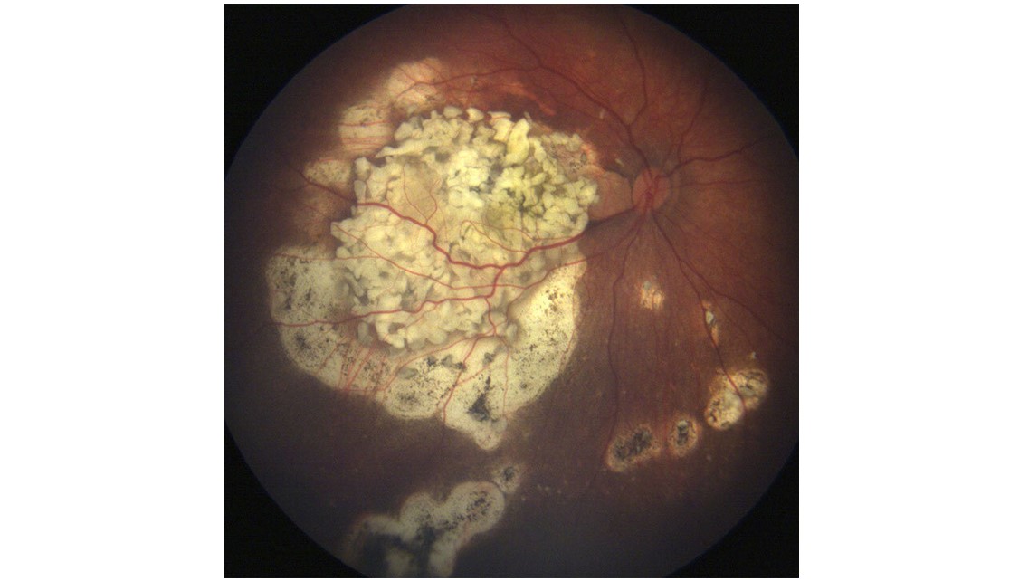 Cercetătorii au descoperit un nou factor molecular pentru retinoblastom, crescând şansele pentru o ţintă specifică de tratament