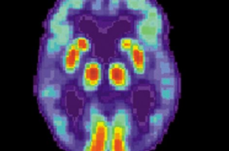 O nouă ipoteză: Boala Alzheimer este cauzată de scăderea proteinelor beta-amiloid din creier şi nu de formarea plăcilor de amiloid