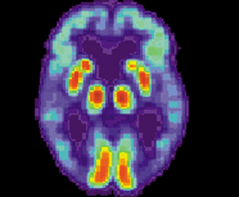 O nouă ipoteză: Boala Alzheimer este cauzată de scăderea proteinelor beta-amiloid din creier şi nu de formarea plăcilor de amiloid