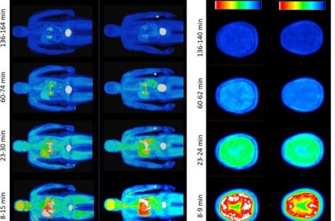 Moleculă radioactivă pentru detectarea pierderilor de mielină în bolile neurologice, testată pentru prima dată la om