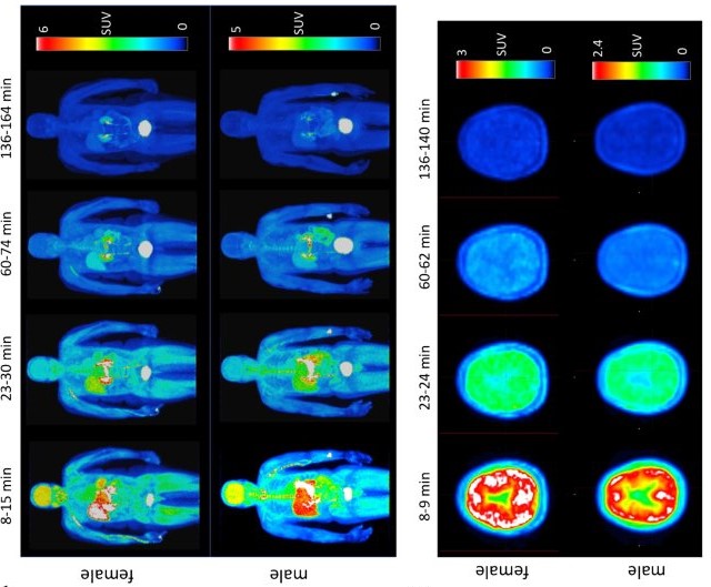 Moleculă radioactivă pentru detectarea pierderilor de mielină în bolile neurologice, testată pentru prima dată la om