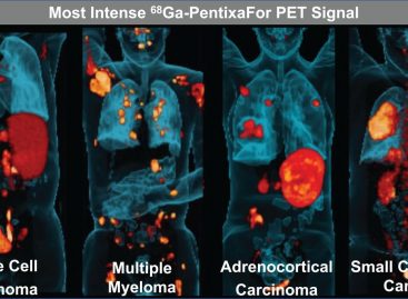 Agent PET care detectează eficient mai multe tipuri de cancer