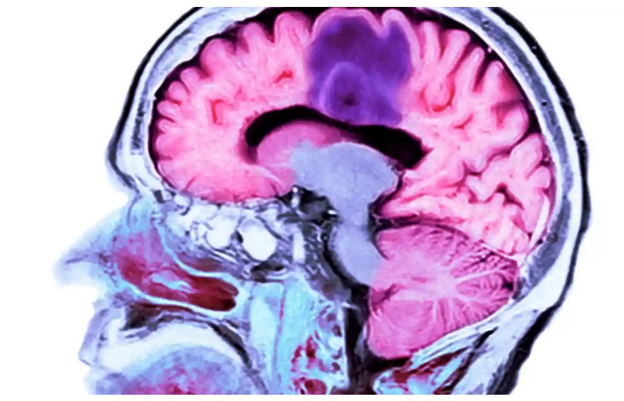 VIDEO Un tratament împotriva cancerului cerebral a eliminat aproape complet tumora în doar cinci zile