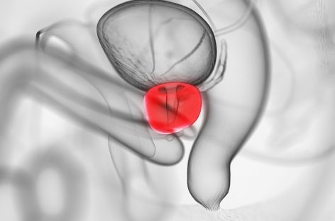 Dezvoltarea unei terapii pentru cancerul de prostată rezistent la tratament: un studiu clinic restrâns indică o supraviețuire fără progresie de 40%